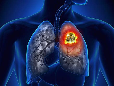 hình ảnh ung thư phổi