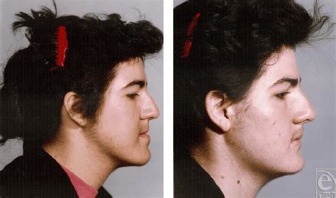 habsburg jaw modern examples