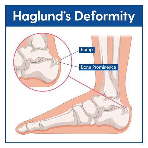 haglund's deformity