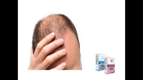 What Causes Hair Loss During Pregnancy? How to Stop Hair Loss