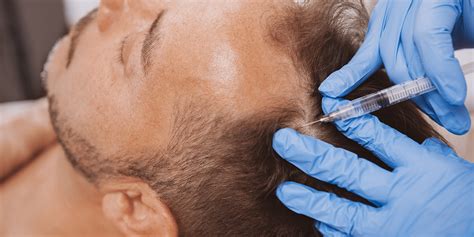 PRP Hair Loss Therapy for Tifton & Albany, GA Solé Medical Spa