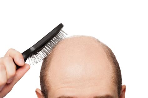 Top 5 Reasons for Hair Loss in Young Age eVaidya Health Articles