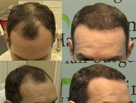 2000 FUE Grafts Case Study Norwood Class III Carolina Hair Surgery