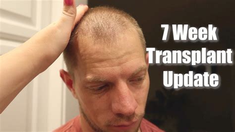 How Many Years Does A Hair Transplant Last Fashion Hairstyle