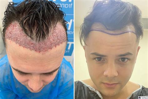 11 FUE hair transplant Mexico, Dr. Nader (part 2/day12) YouTube