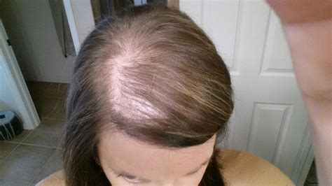 Fern & Blush Postpartum Hair Loss What To Expect