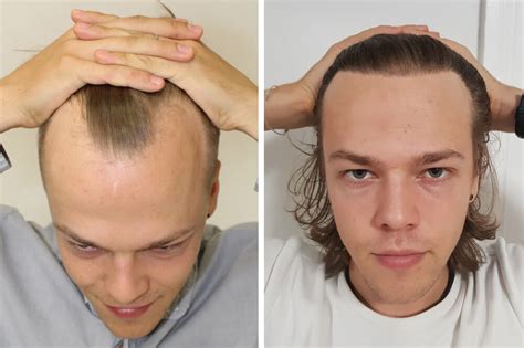 Hair Loss Receding Hairline Treatment   Tips  How To And Faqs