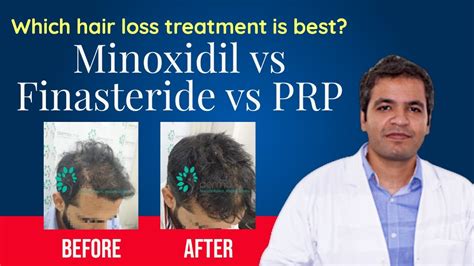 hair loss treatment minoxidil and finasteride