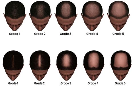 Hair Loss X Chromosome