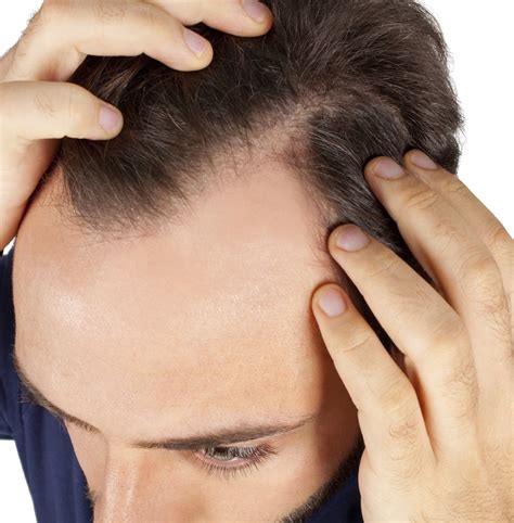 How To Solve Hair Loss In Young Men Problem The wrong ways to take