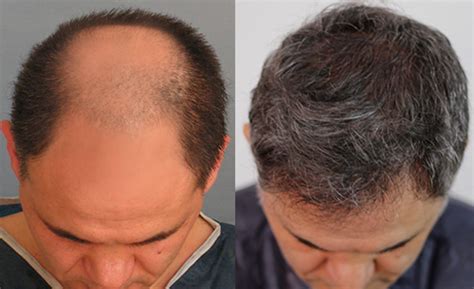 Hair Restoration Photos Melbourne, FL Patient 57533