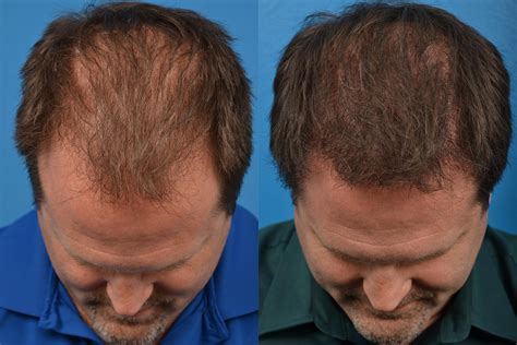 Before & After Photos Northwest Hair Restoration Dr. Robert Niedbalski