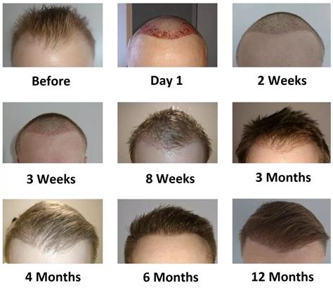 3 months post hair transplant HairTransplants