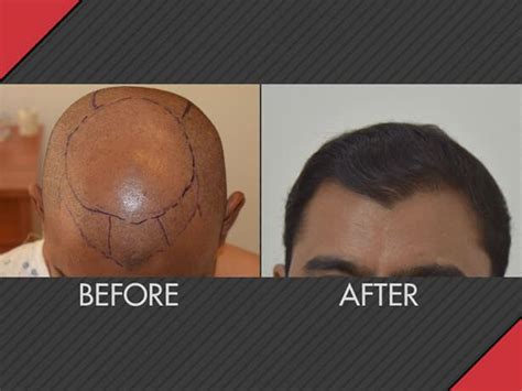 Hair Transplant Cost Advanced Hair Restoration Alexandria, Virginia