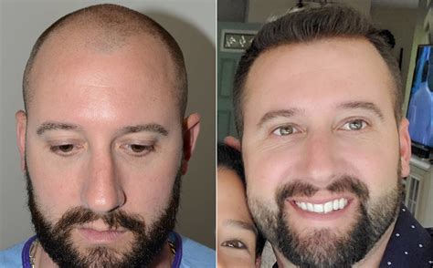 Hair Restoration Photos Melbourne, FL Patient 57533