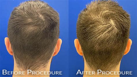 Gender Confirming Hair Restoration Chicago Hair Treatment Wicker Park