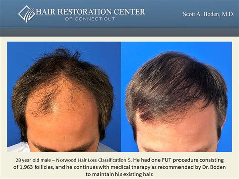 Slide6 Hair Restoration Center of CT FUE Hair Transplant