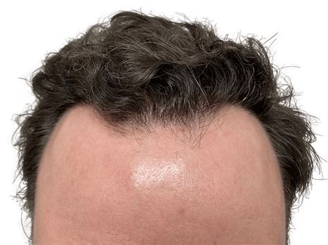 Best Hair Transplant Dallas Revive Hair Restoration in Dallas TX