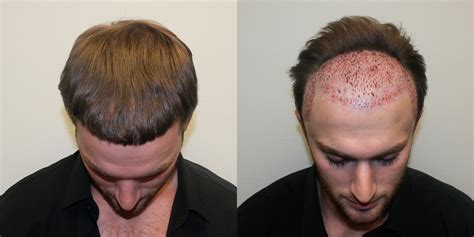 Hair Restoration Before and After Dr. Jeffrey Wise