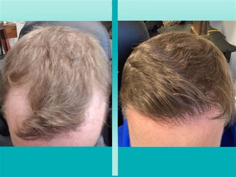 Hair Restoration Delaware Hair Loss Treatment New Castle Hair Loss