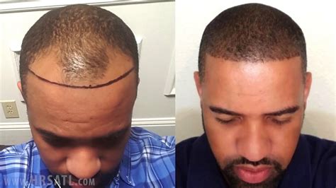 Hair Transplant On African American Male With Shaved Head Dr. Brett
