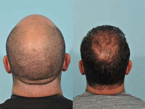 Hair Transplant Before & After 9 Rawnsley Hair Restoration