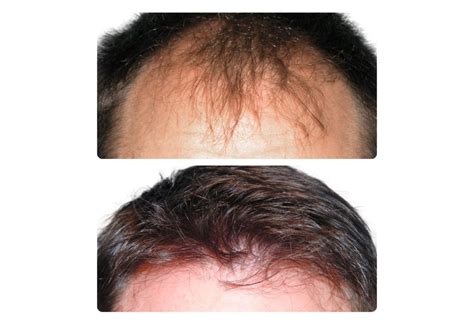 Before & After Hair Restoration Photos Grand Rapids, MI Holt Hair