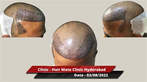 hairtransplantclinicsinhyderabad Hair Transplant Dubai Cost