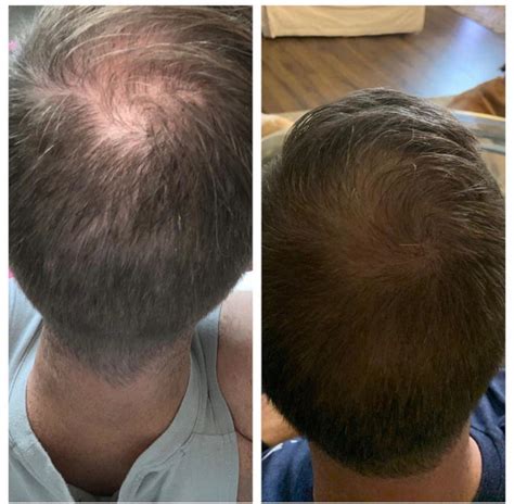Best Hair Transplants Knoxville, Tennessee Hair Replacement Surgery