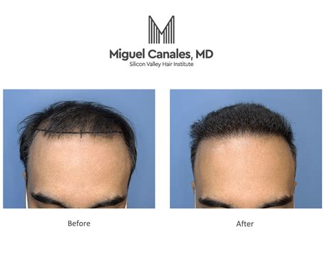 FUE Hair Transplant Package in Cancun, Mexico YouTube