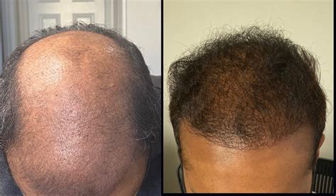 Videos of Hair Restoration Michigan Hair Restoration