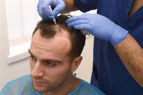 PRP Hair Restoration PRP Hair Restoration Near Me Read Our Reviews