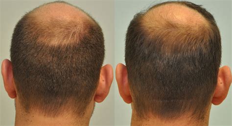 PRP Hair Restoration New Jersey Hair Loss Treatments
