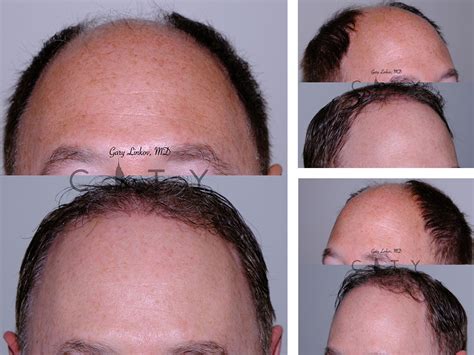 Best Hair Transplant NYC Revive FUE Hair Restoration in New York