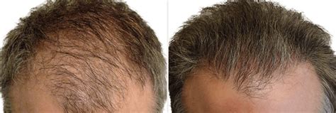 Hair Transplant Langhorne Hair Restoration Philadelphia PA