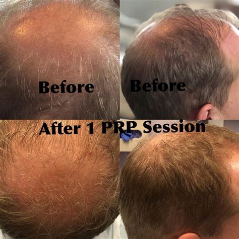 Platelet Rich Plasma (PRP) Before & After Photos Hair Restoration of