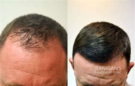 About Raleigh Hair Concepts Hair Restoration in Raleigh, NC