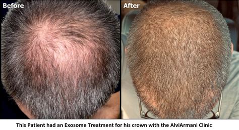 Exosomes Hair Rejuvenation Revivify Medical Spa