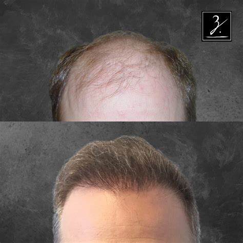 Private Hair Restoration Consultation PPC LA Ziering Medical