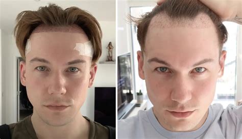 1 month after FUT Hair Transplant in Cape Town, South Africa in 2021