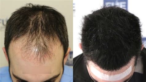 FUE Hair Transplant (3467 + 1000 grafts in NW Class IV A), Dr. Juan