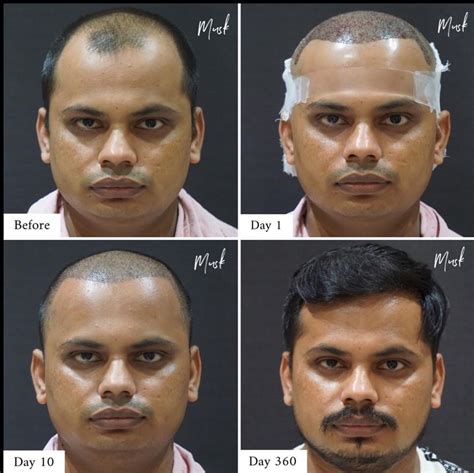 Hair Transplant 3 Month Results