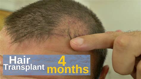 FUE PostOp Pictures 4 Months Hair Transplant Story