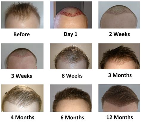 FUE PostOp Pictures Weeks 3 to 6 Hair Transplant Story