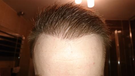 FUE PostOp Pictures 5 Months Hair Transplant Story
