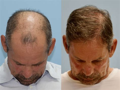 Before And After Hair Transplant Photos Before & After 5,000 Grafts!