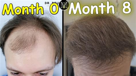 Before and 8 months after hair transplant. Hair loss, Hair transplant