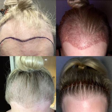 Evolution of Transplanted Hair, from Day 1 to 9 Months YouTube