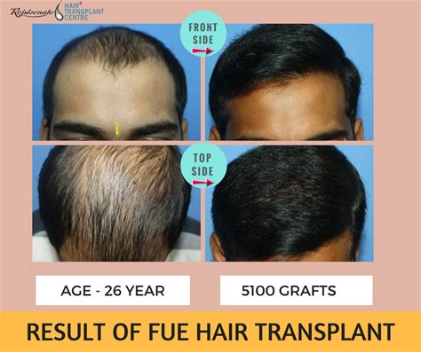  79 Stylish And Chic Hair Transplant And Age Limit Trend This Years