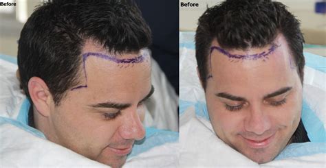 hair transplant at temples